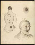 Drawing of two sufferers of the Pox. One person's back and another's face, showing large pustules and growths