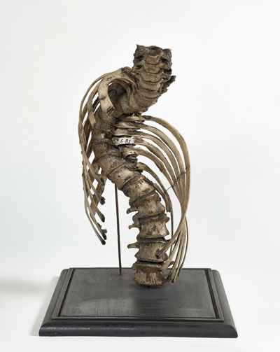 William Hunter and assistants, Severe lateral curvature of the spine, 1746–83 © The Hunterian, University of Glasgow.
