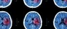 Image of ct scans of brain