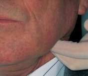 jugulodigastric