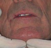 lymph_node