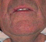 submandibular