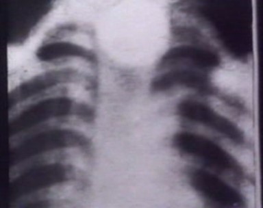 x ray of coin in gullet