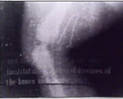 x ray of leg