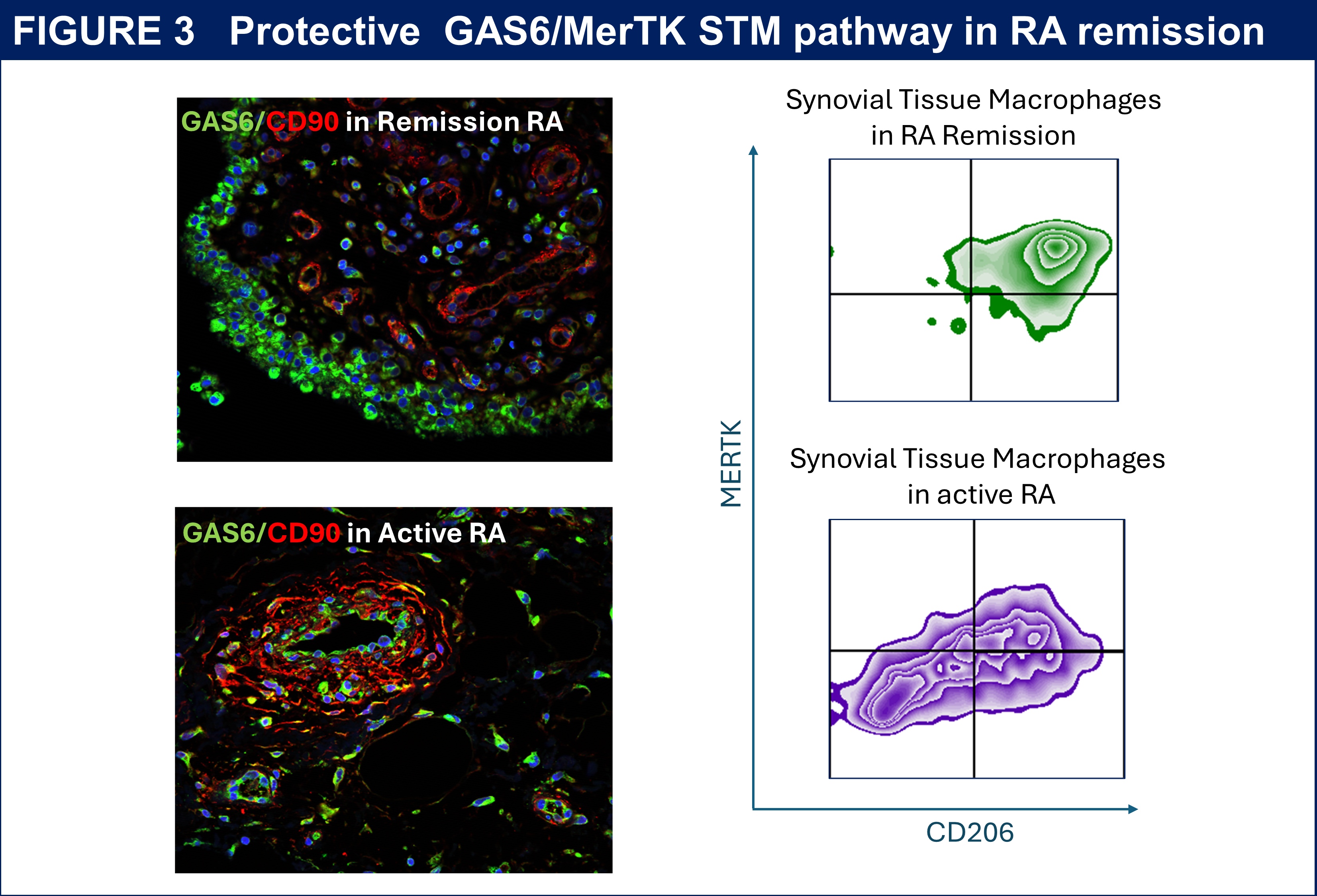 A slide of research by Dr Aziza Elmesmari showing Protective GAS6/MerTK STM pathway in RA remission 