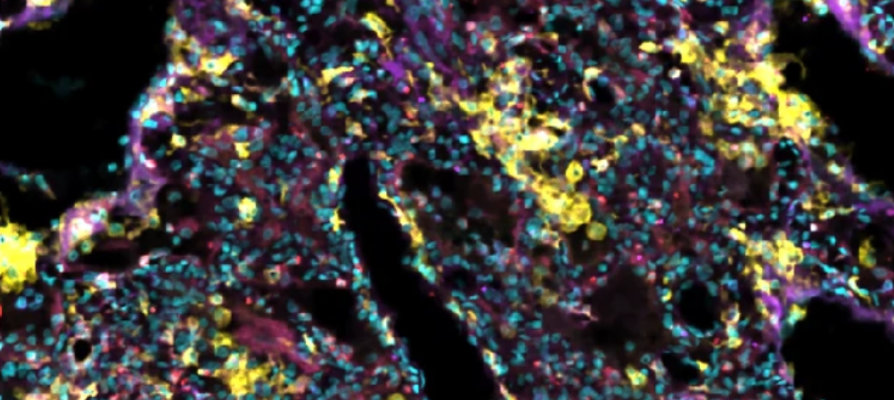 Fig. 2: IMC reveals an immunopathological landscape of COVID-19 in Malawian patients driven by alveolar macrophages. (c) c, Representative denoised IMC images from one of 84 ROIs for patients with COVID-19 show abundant CD206high macrophages (yellow) and few neutrophils (CD66b, red) and monocytes (CD14, purple). Scale bar, 140 μm.
