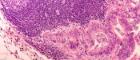 Close-up of colon cancer cells in purple and pink