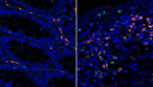 Microscopy images of colon tissue samples of IBD patients under remission (left) and with active disease (right). Granzyme A (green fluorescence) is elevated in the intestinal tract of IBD patients (right). Credit: Emily Thompson.