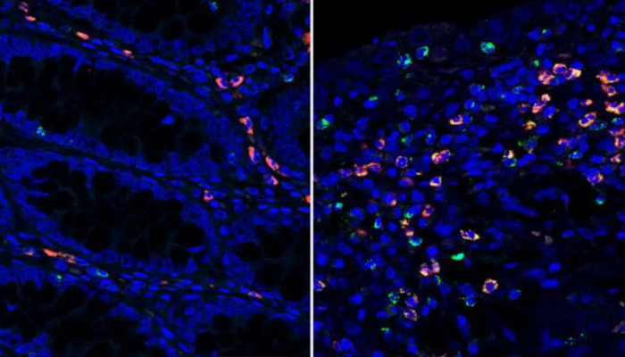 Microscopy images of colon tissue samples of IBD patients under remission (left) and with active disease (right). Granzyme A (green fluorescence) is elevated in the intestinal tract of IBD patients (right). Credit: Emily Thompson.