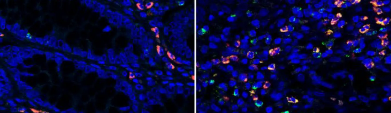 Microscopy images of colon tissue samples of IBD patients under remission (left) and with active disease (right). Granzyme A (green fluorescence) is elevated in the intestinal tract of IBD patients (right). Credit: Emily Thompson.