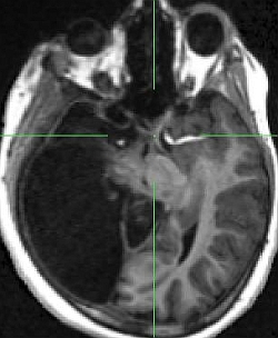An MRI scan shows how the nasal retinal optic nerve has connected to the left hemisphere of the brain (image is inverted).