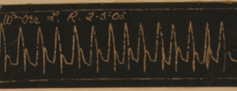 Early ECG tracing with permission Yorkhill Archives