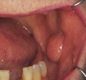 fibroepithelial