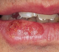 lower_lip2