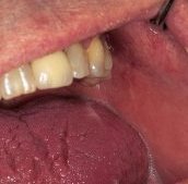 upper_buccal