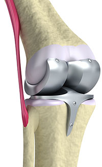 Knee replacement