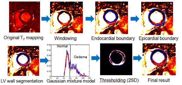 oedema scar segmentation