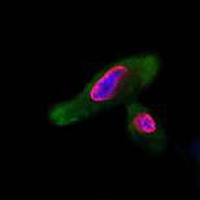 LBC cells stained with MCM (red) a cellular DNA replication protein and HPV E4 protein (green). Cell nuclei are stained with DAPI (blue). This shows that these two cells are infected with HPV. 