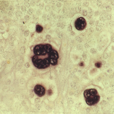 EBV EBER in situ hybridised cells 400x400
