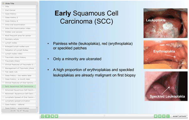 Oral cancer interactive 