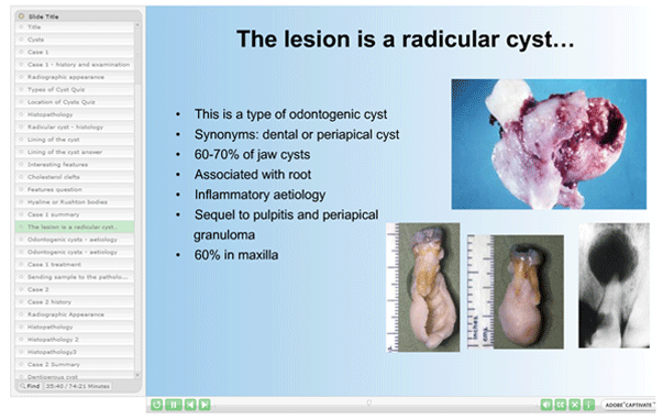 Common Odntogenic Cysts 