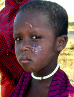 Boy with facial scar from dog attack, Tanzania. Credit Katie Hampson