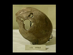 Syphilitic Skull with a large hole due to disease