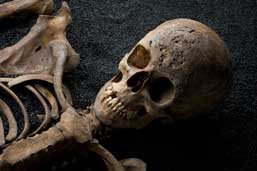 Cross Bones, Redcross Way, SE1 1598 – 1853 / Post-Medieval female / aged 18 – 25 
Syphilis, residual residual rickets

