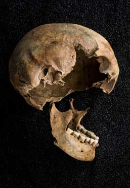 Roman West, 46 – 50 Holborn Viaduct, EC1 1st – 5th centuries / Roman male / age unknown 
Small round lesions in skull caused by multiple myeloma
