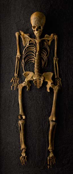 Cross Bones, Redcross Way, SE1 1598 – 1853 / Post-Medieval female / aged 18 – 25 
Syphilis, residual rickets

