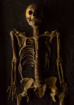 Cross Bones, Redcross Way, SE1 1598 – 1853 / Post-Medieval female / aged 18 – 25 
Syphilis, residual residual rickets 
