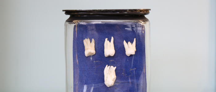 Image of  human Wisdom Teeth