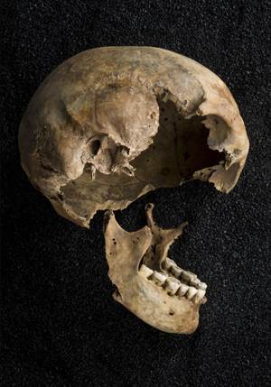 Image of a damaged skull