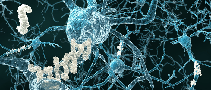 Alzheimer's disease - neurons with amyloid plaques