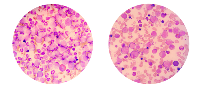 Microscopic views of a blood smear from leukemia patient