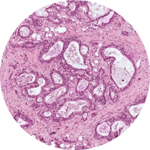 Pancreatic cancer image