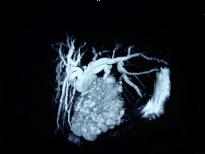 Pancreatic cancer image