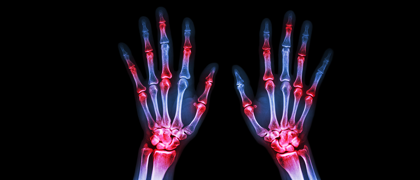 Psoriatic Arthritis x-ray