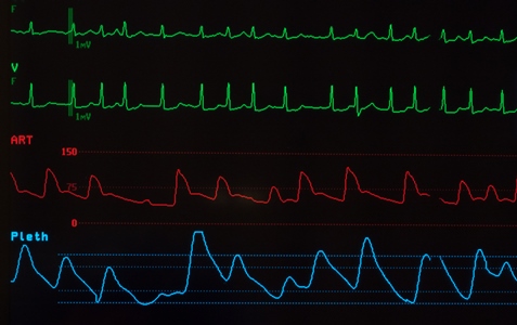 Atrial Fibrillation (AF) Trial Image