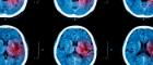 Image of CT scan of brain