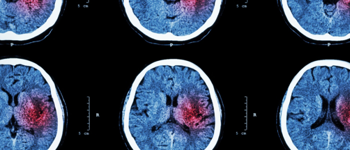 Image of CT scan of brain