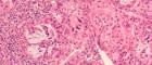 Image of a pancreatic cancer histology section