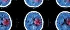 Image of ct scans of brain