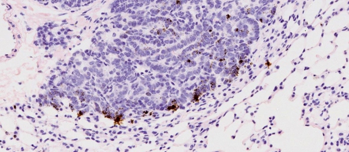 LungCancer700