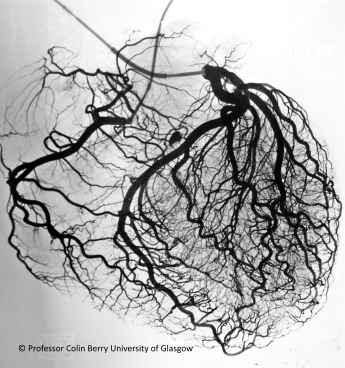 Post-mortem injection of the coronary artery tree, used by William Fulton to demonstrate coronary thrombus as the cause of acute myocardial infarction. © Professor Colin Berry University of Glasgow