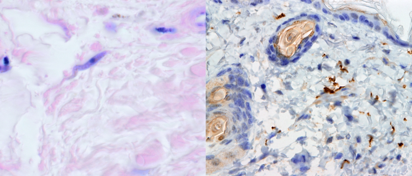 (L-R) T. b. gambiense in patient sample from DRC, H&E staining. T. b. brucei in mouse skin during experimental infection, IHC staining anti-ISG65