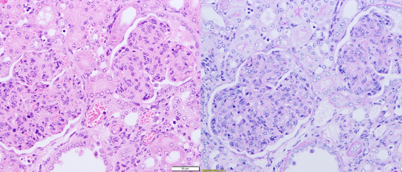 Mouse ABIN1 [D485N] knock in – kidney: severe glomerulonephritis characterised by increased glomerular size, hypercellularity and thickening of the mesangium. H&E and PAS staining.