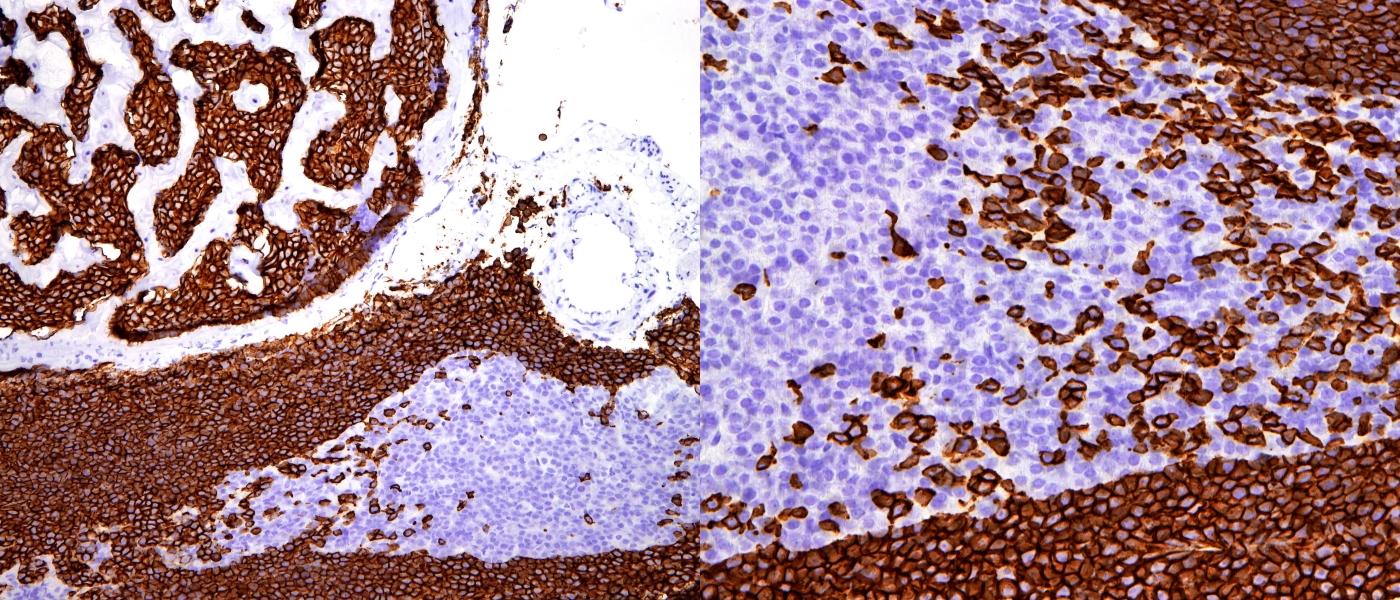 Anti-human CD45 staining of ovarian tissue from an NSG mouse xenografted with the human acute lymphoblastic leukaemia cell line SDI.