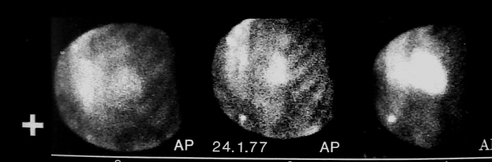 Western scan b infarct 1970s