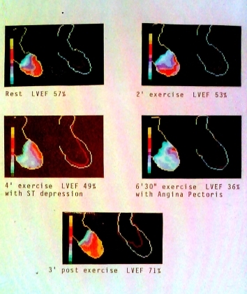 First pass cardiac scans Nuclear Medicine